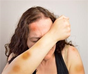 Frau mit blauen Flecken: Häusliche Gewalt