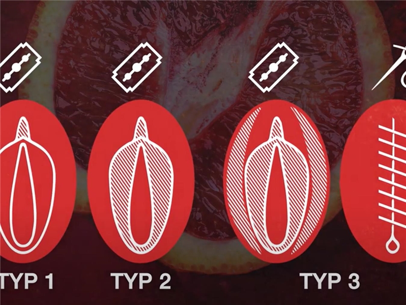 Illustrationen von verschieden beschnittenen Vaginen.